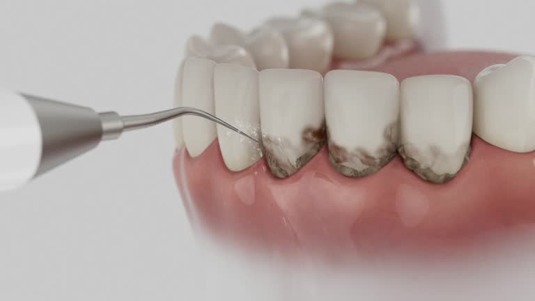 Trusted Wisdom Tooth Removal service in Chadbourn, NC - Dentist Open Now